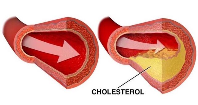 Těchto 12 potravin rozpustí a vyplaví usazený cholesterol z vašich cév