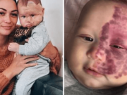 Máma nechala svému dítěti odstranit velké mateřské znaménko a lidé ji označili za „monstrum“.
