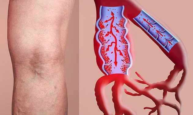 thrombosis