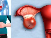 Smícháním těchto 2 látek odstraníte jakoukoliv cystu nebo fibrom