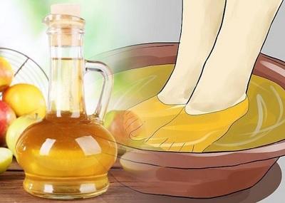 Treatment_of_varicose_veins_with_apple_vinegar