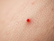 ŠOKUJÍCÍ ČERVENÁ TEČKA NA KŮŽI: Tohle jste o ní NEVĚDĚLI! Může jít o životně důležitý signál!